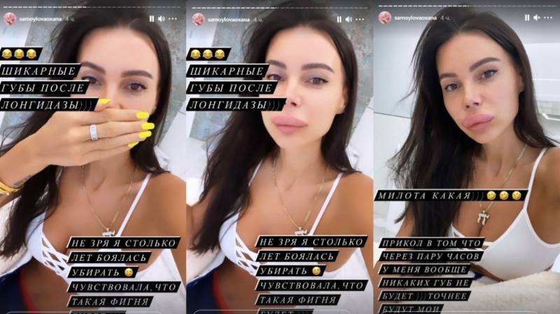 Оксана Самойлова шокировала поклонников чересчур огромными губами