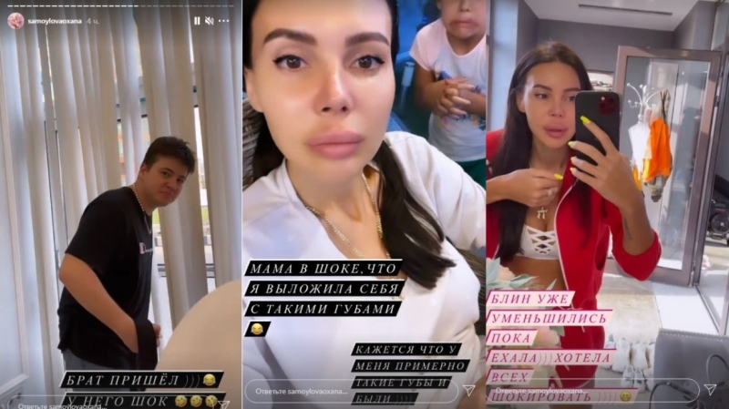 Оксана Самойлова шокировала поклонников чересчур огромными губами