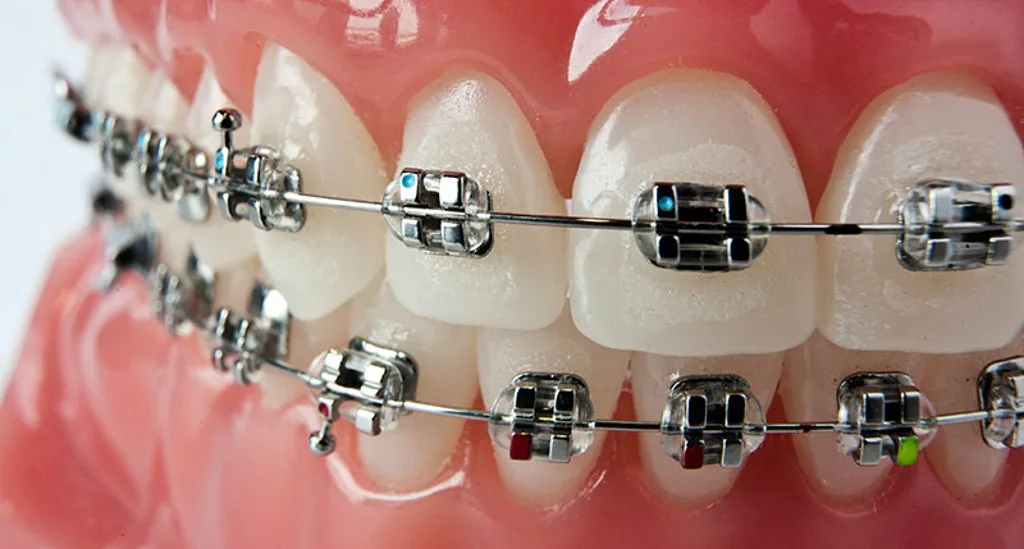 Металлические брекеты: надежный путь к красивой и здоровой улыбке